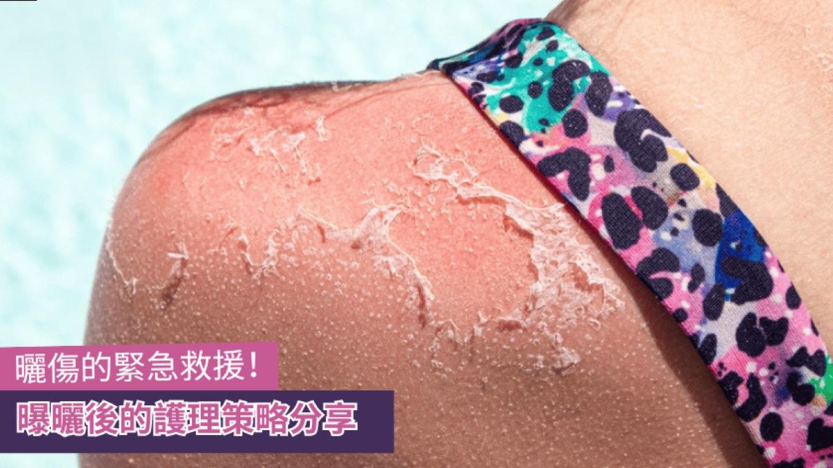 曬傷的緊急救援　曝曬後的護理策略分享