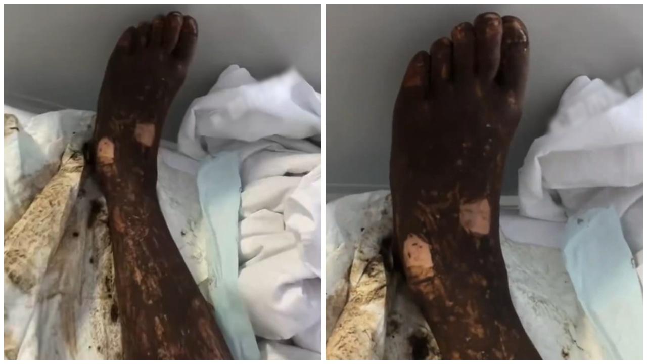 百步蛇鬥青竹蛇，男子睇手機誤闖戰場，罕有同遭2蛇咬傷。(微博)