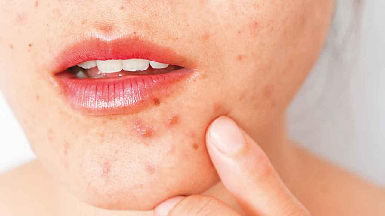 痔瘡、暗瘡、痤瘡與玫瑰痤瘡