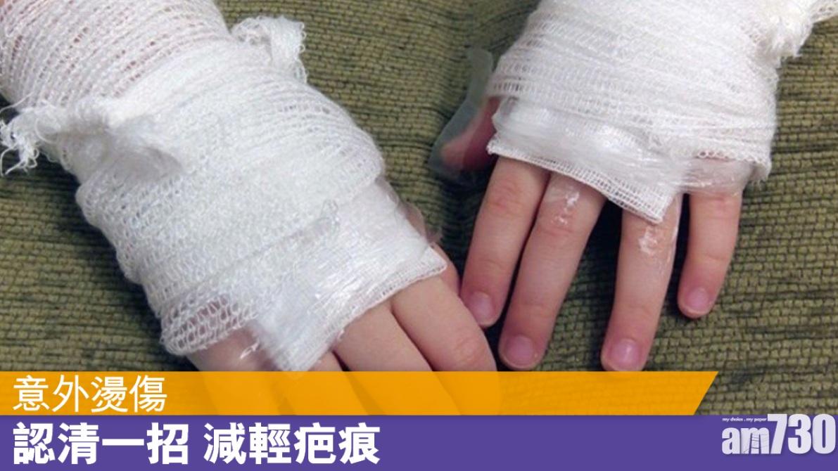 小燙傷處理 做啱步驟可減低疤痕機會