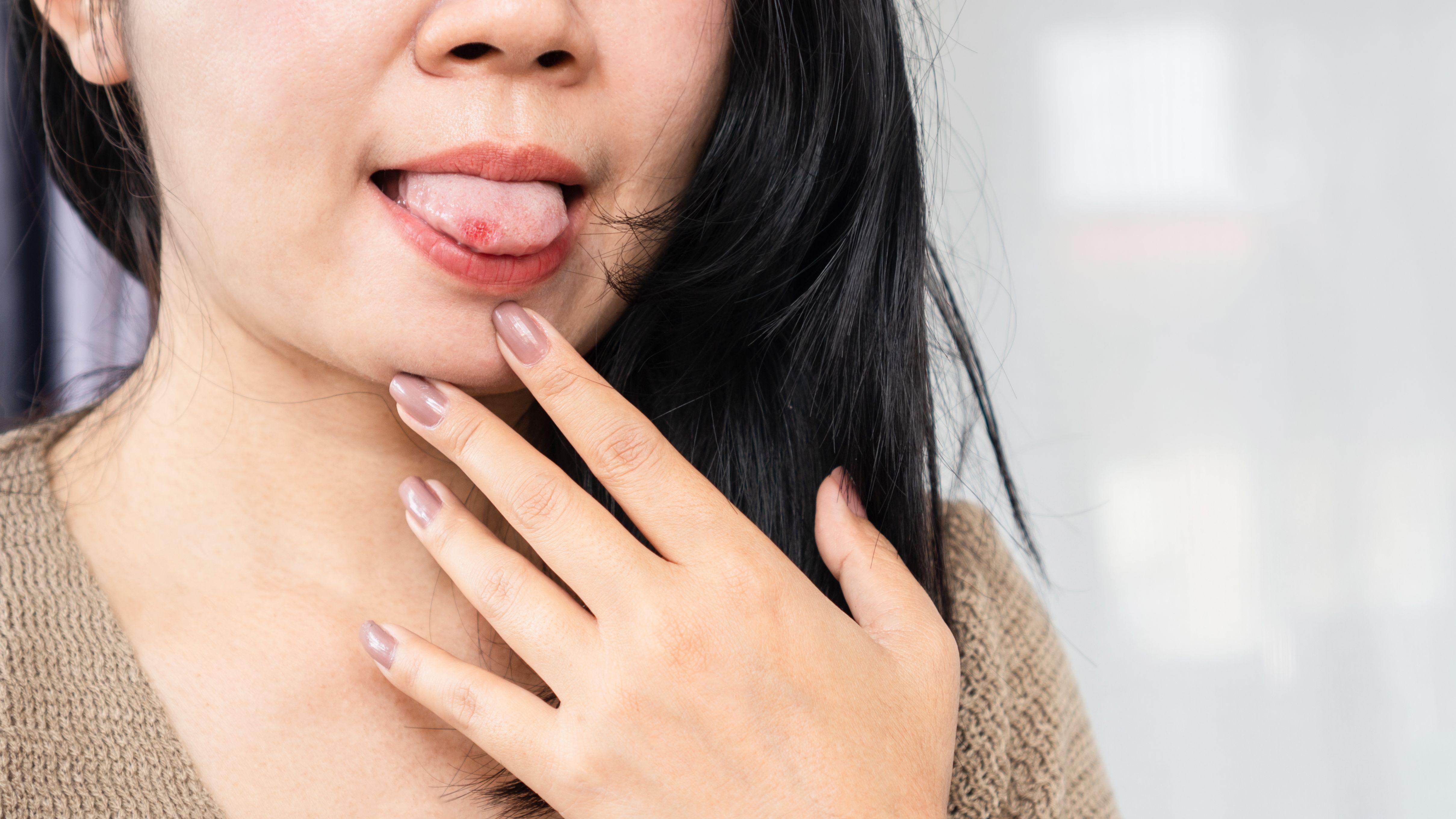 生痱滋 口腔潰瘍  上火 熱氣 壓力 口腔癌 癌症 自體免疫疾病