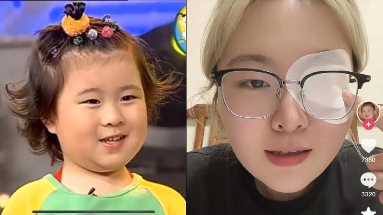 美女病｜童星「秦虹一枝花」患發病率僅0.03%罕見病 25歲右眼失明