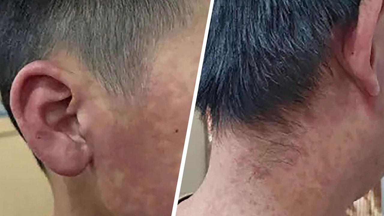 三水區政府發布多張基孔肯雅熱患者出現皮疹的照片。(微信公眾號「三水發布」)