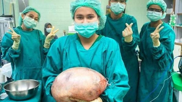 沙敦婦產科診所一名醫生發布照片，可見醫護人員捧著該巨大卵巢囊腫，頗為嚇人。(互聯網)