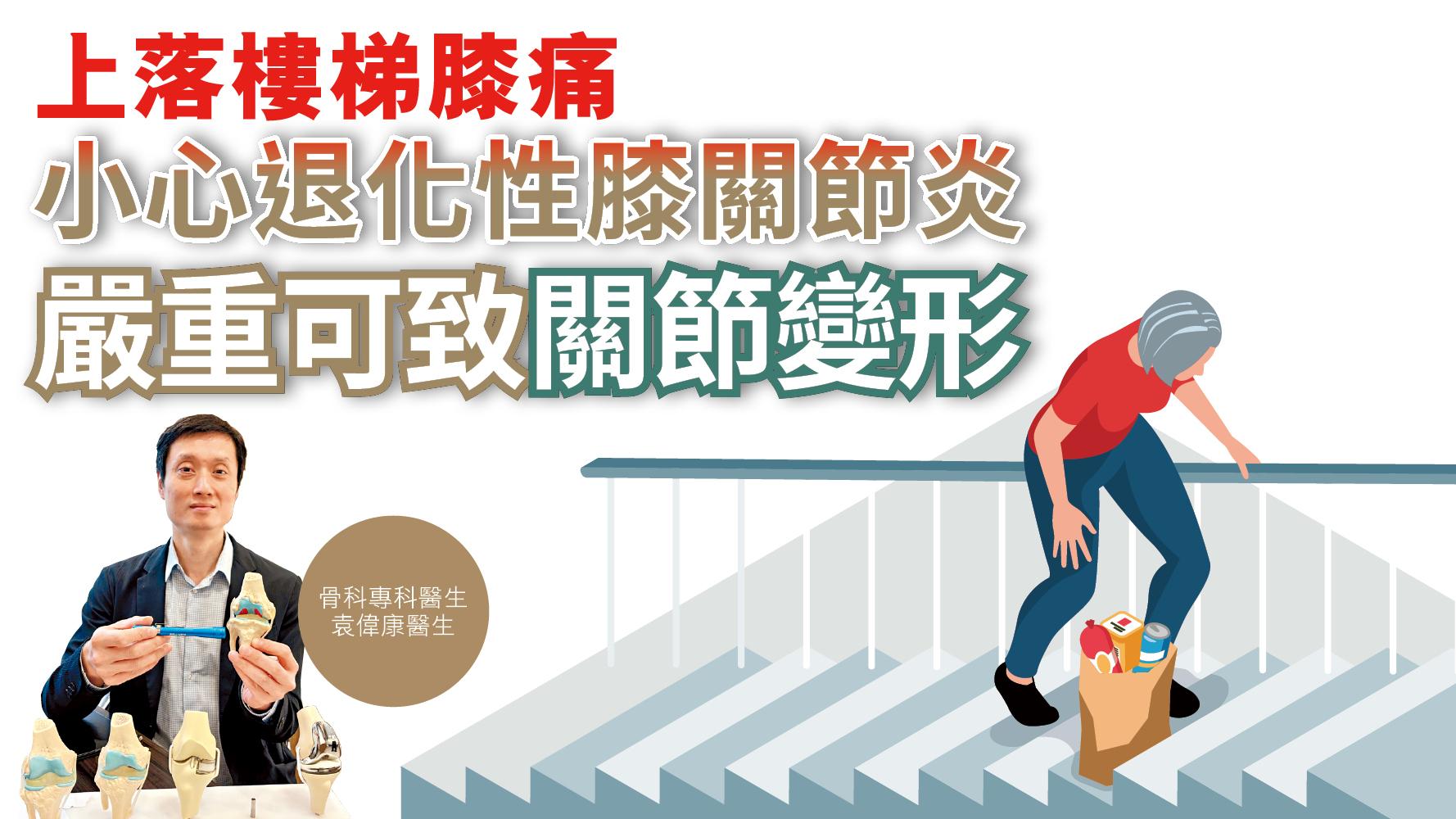 健康解碼｜上落樓梯膝痛 小心退化性膝關節炎 嚴重可致關節變形