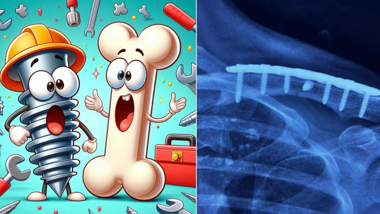 骨折癒合，螺絲滑牙？