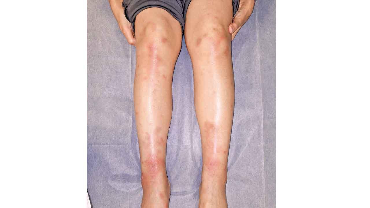 紅腫非小事！結節性紅斑揭身體隱患