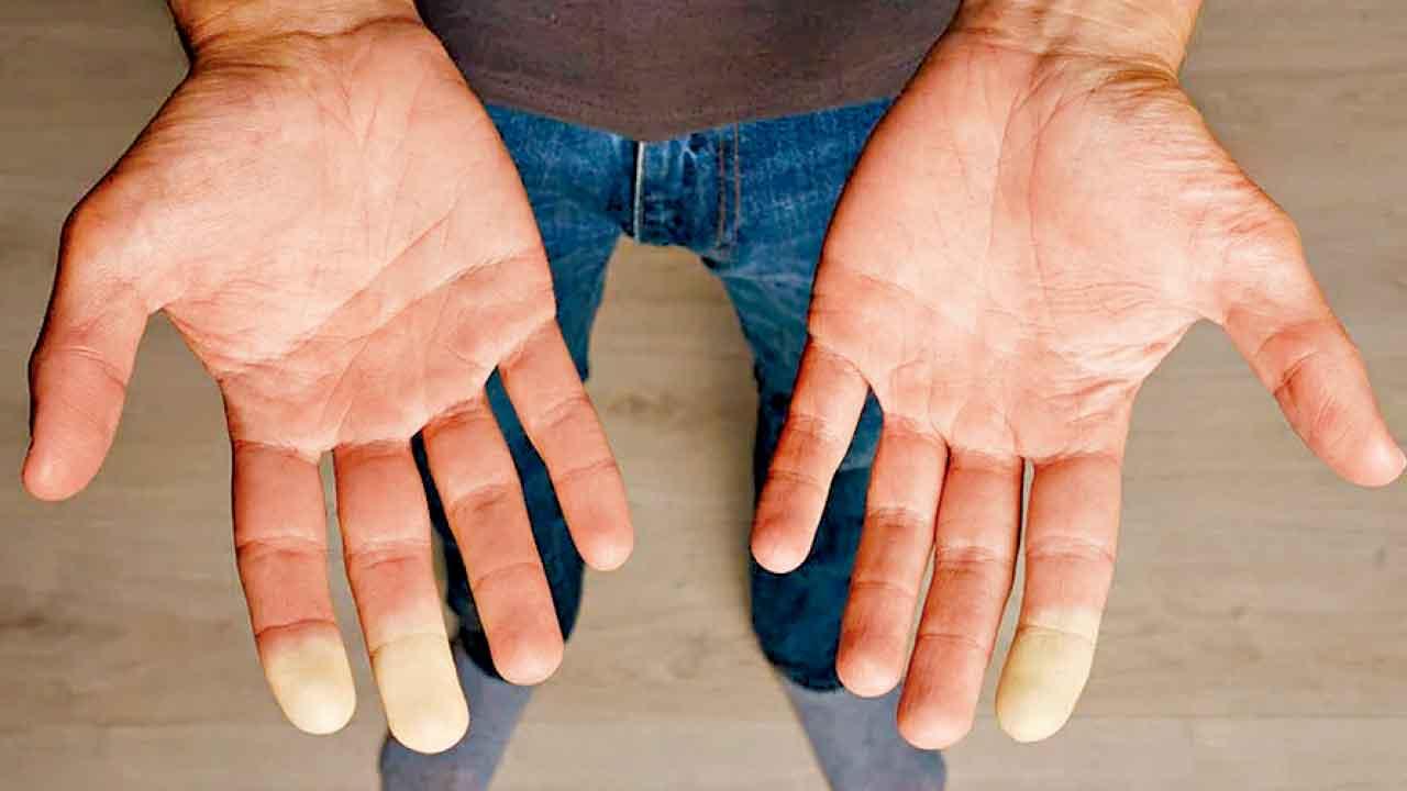 硬皮病：讓皮膚變成石頭的疾病