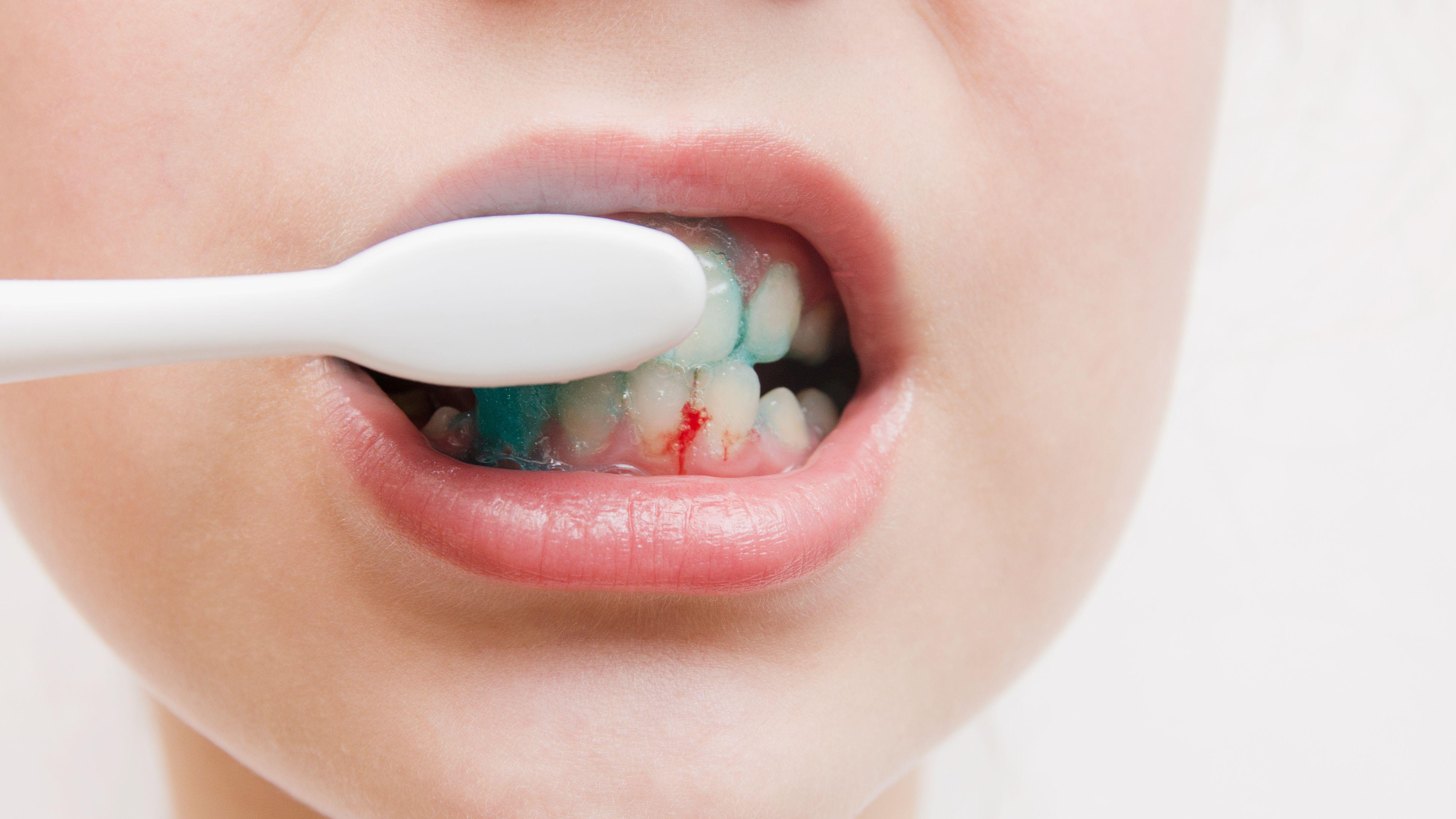 刷牙流血 體型 口腔健康 牙齒健康 過重 肥胖 牙齦流血 身體發炎