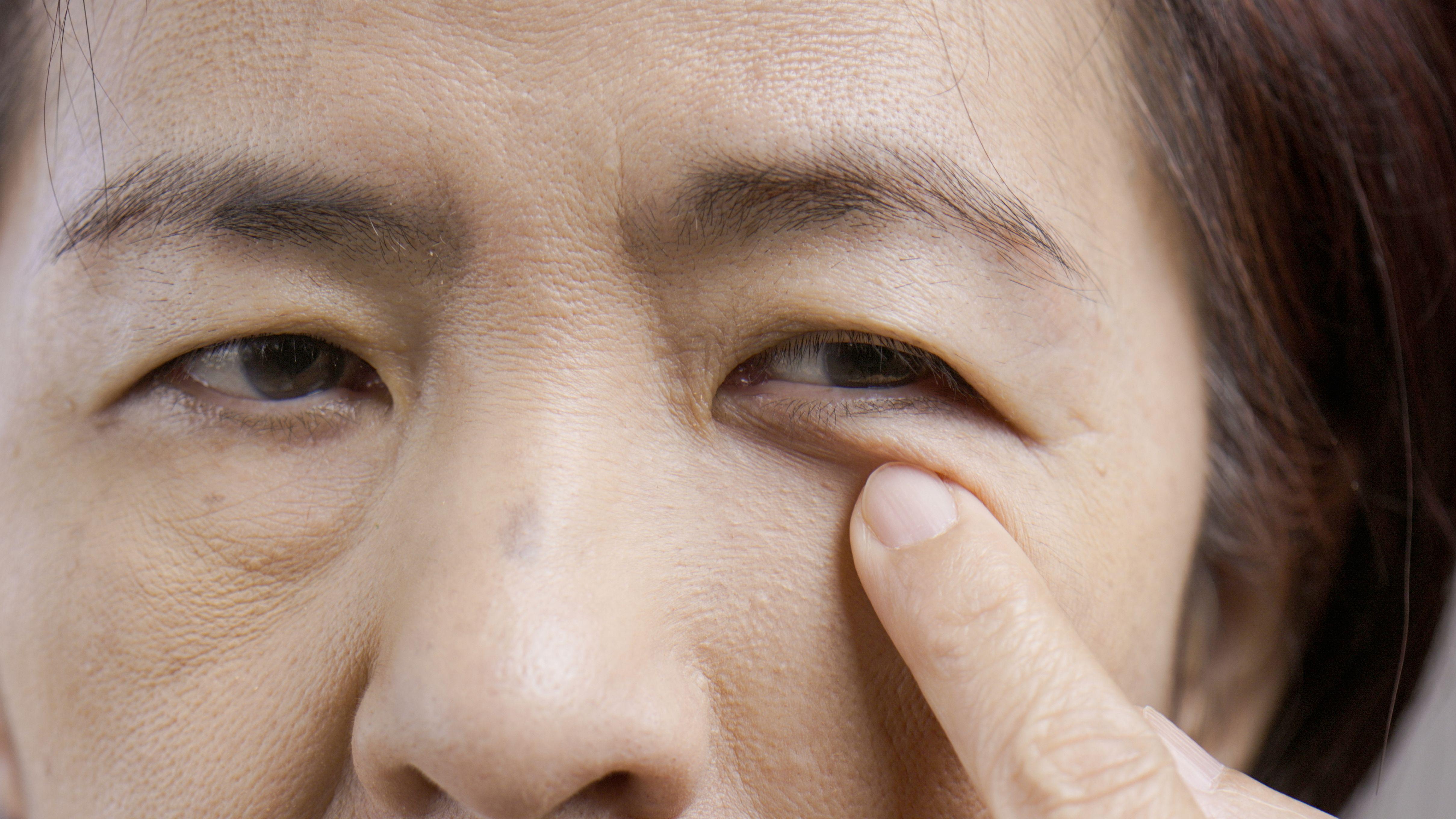 眼皮跳 眼瞼抽搐 肌肉 痙攣 壓力大 睡眠不足 眼部疲勞