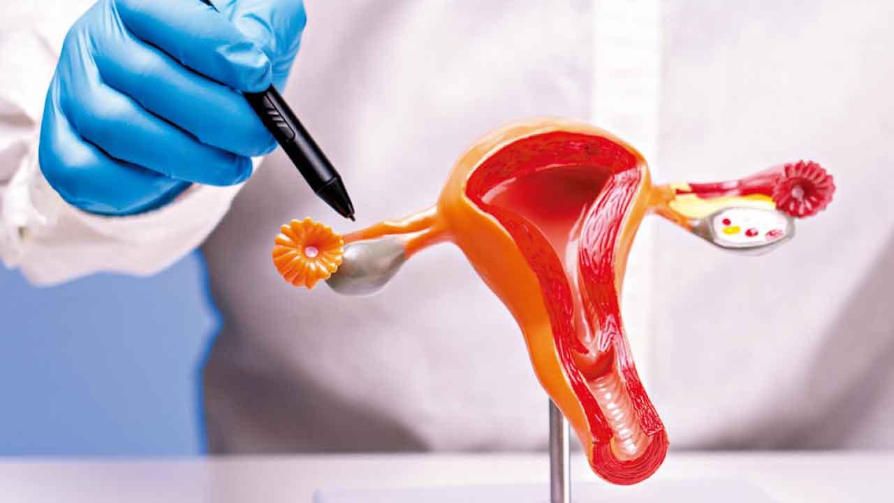 卵巢囊腫可致不育 4種情況須處理