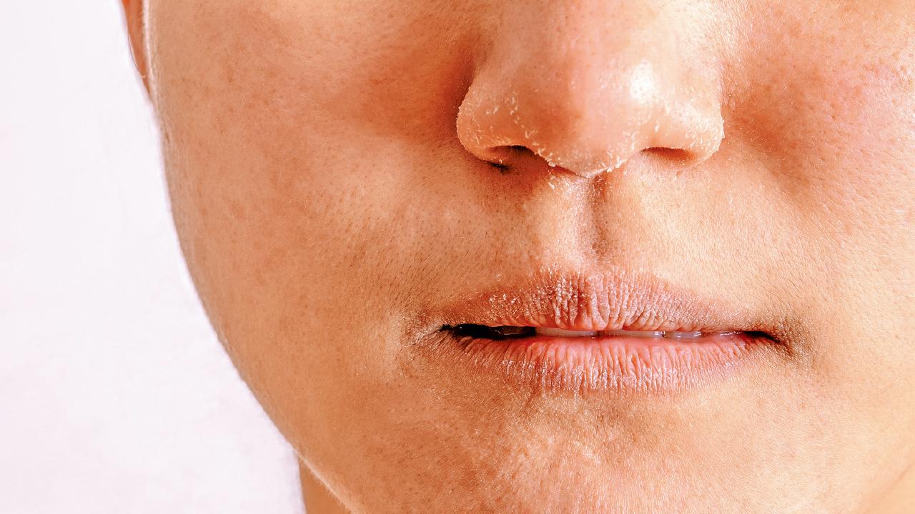 健康生活｜新型治療助濕疹患者走出困境