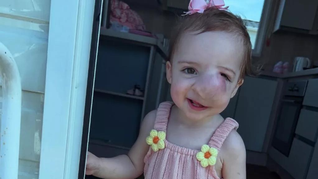 英國1歲女嬰臉現腫塊遭誤診父母傷害造成 腫瘤迅速擴大7個月後離世