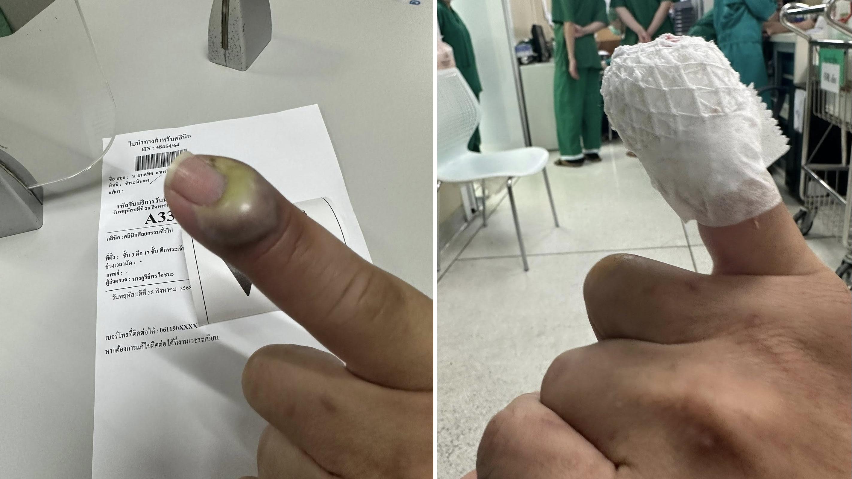 寵物美容師分享照片，可見他右手尾化膿嚴重，經治療後包紮好。(互聯網)