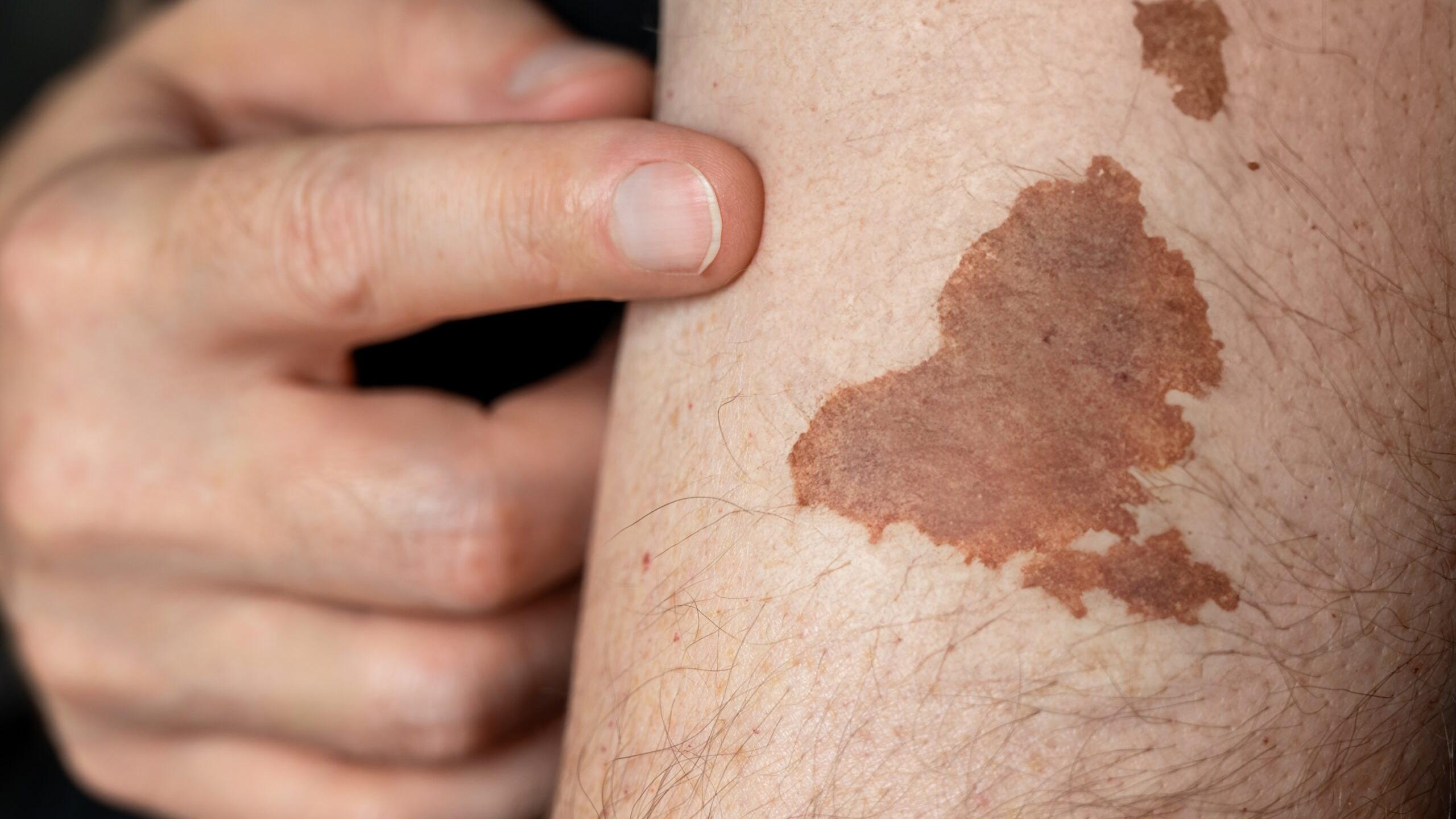 基底細胞癌也可能發生在軀幹，身體若發現異常斑塊甚至不明黑色線條，也請盡早就醫排除惡性變化。