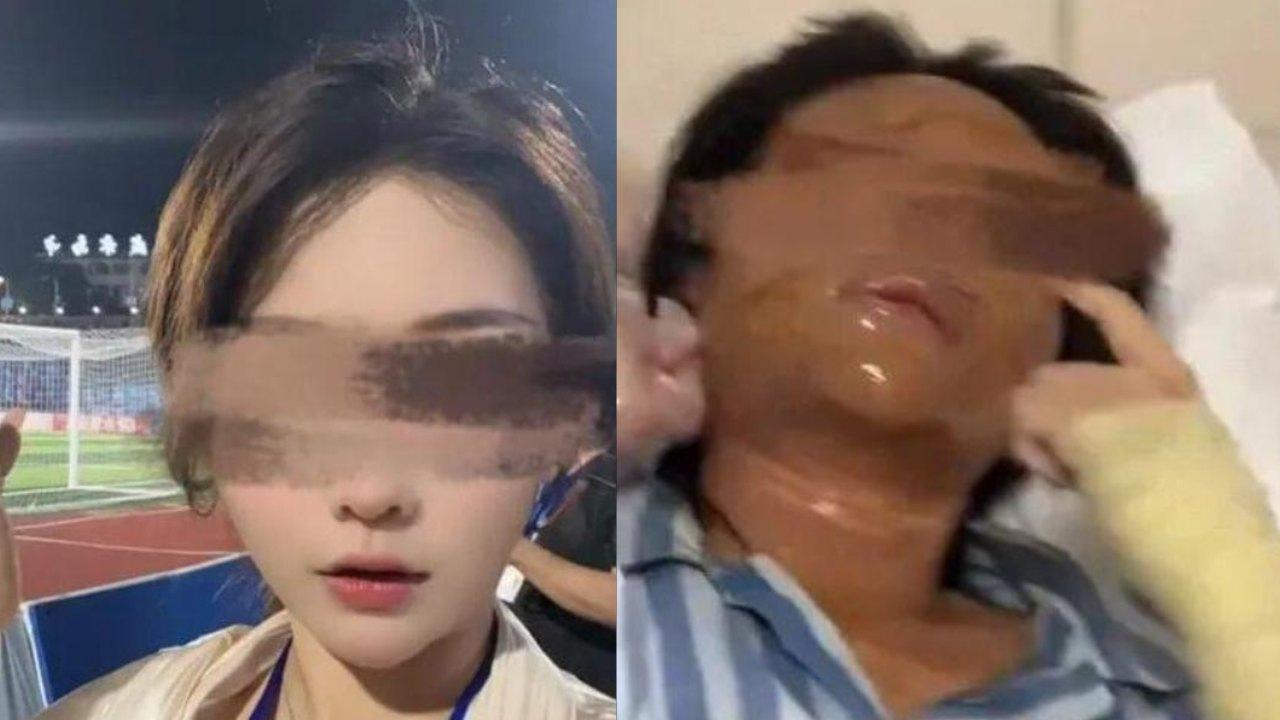 女網紅收「包裹炸彈」被炸至毀容 臉部深二級燒傷