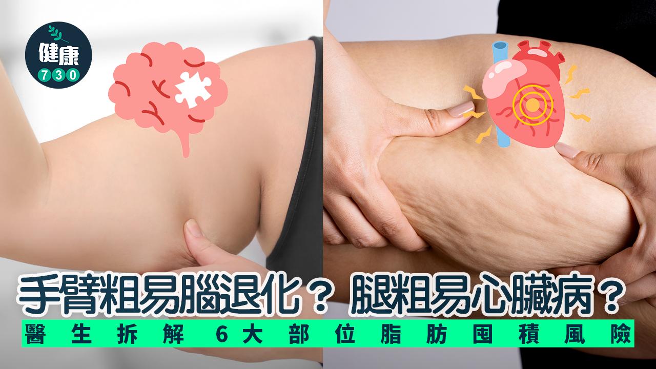 手臂粗  腦退化 腿粗 心臟病 脂肪囤積 脂肪 肥胖 減肥