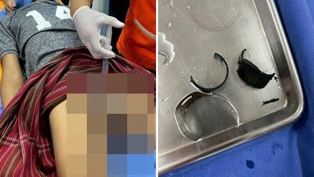 救援隊員用工具切開「鎖住」男子生殖器的環圈(左)，經過一番努力，兩個環圈終移除(右)。(互聯網)