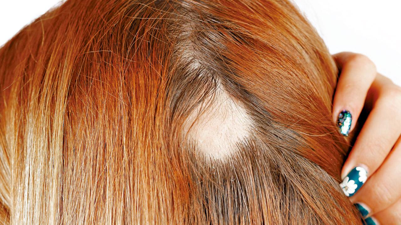 鬼剃頭延遲治療 頭髮難重生