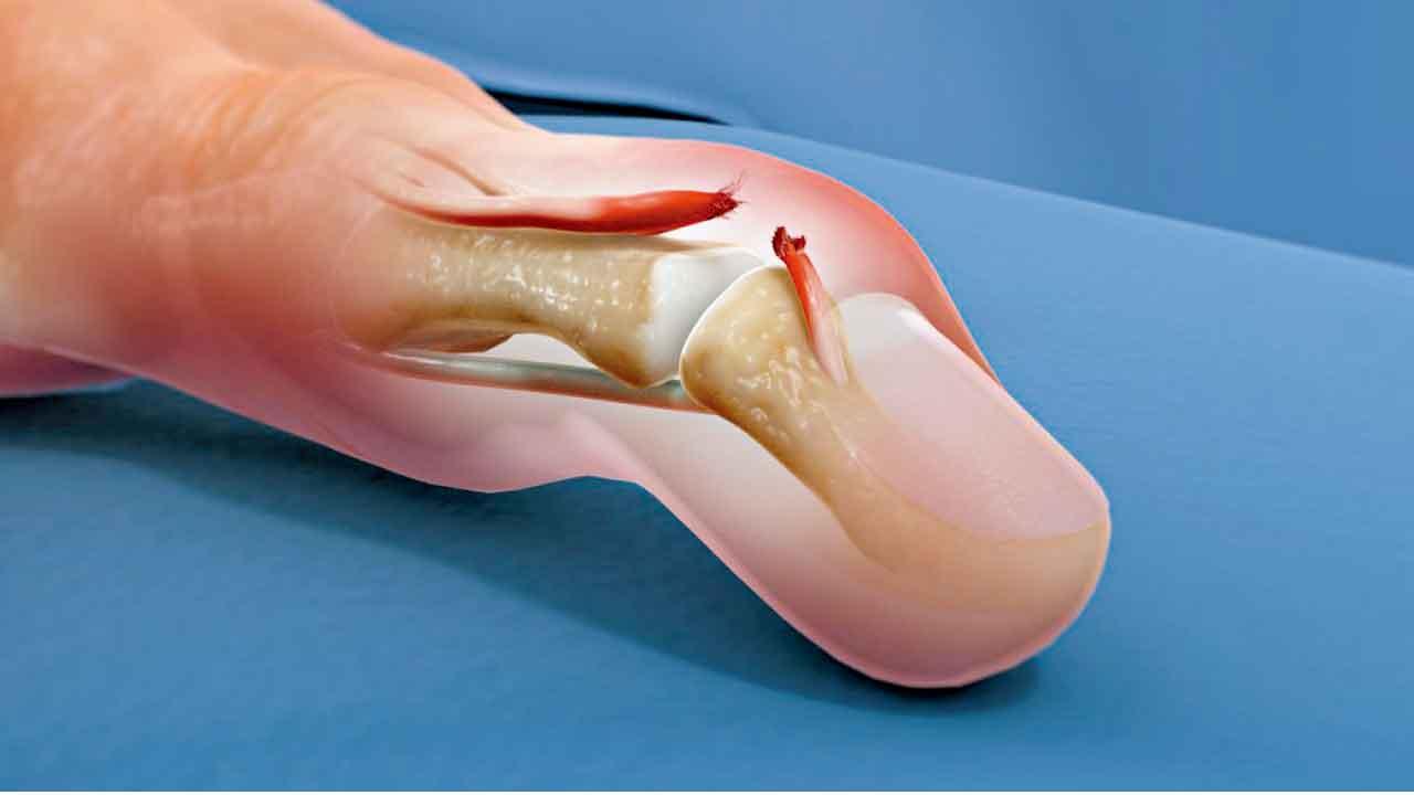 篤魚蛋？骨科醫生教你處理槌狀指