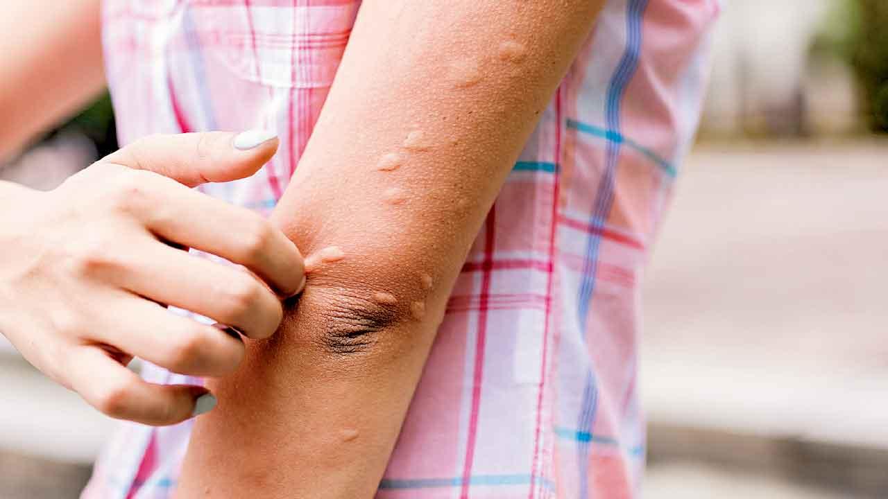 慢性蕁麻疹 用啱藥減發作