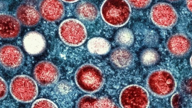 猴痘｜防護中心調查一宗確診個案 涉及一名29歲男子 曾在本港有高風險接觸