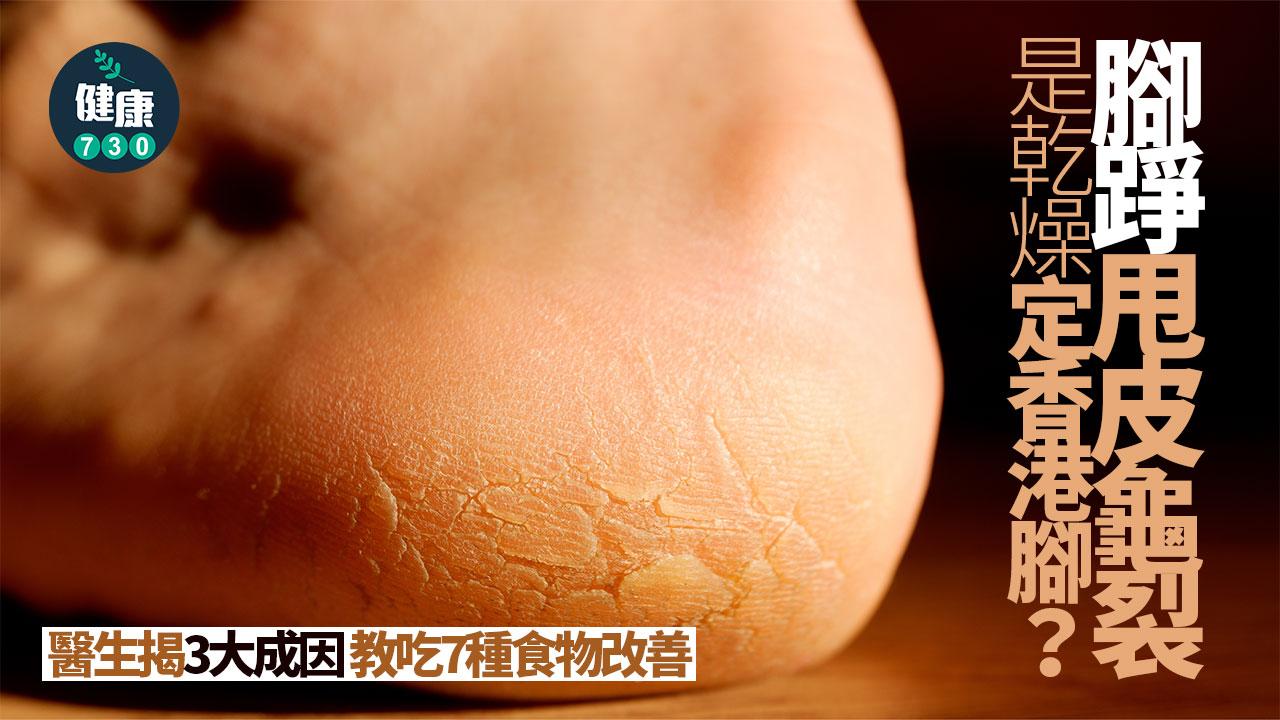 腳踭甩皮 腳踭龜裂 乾燥 香港腳 乳液 乾