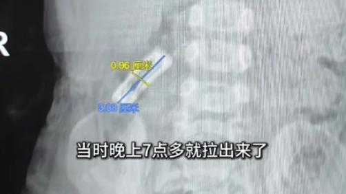 1歲女童誤吞髮夾 靠食金菇自然排出！「see you tomorrow」建奇功