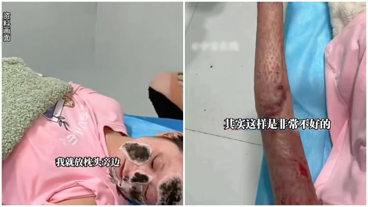 手機枕邊整晚充電爆炸，湖北女慘毀容全身燙傷。(微博)