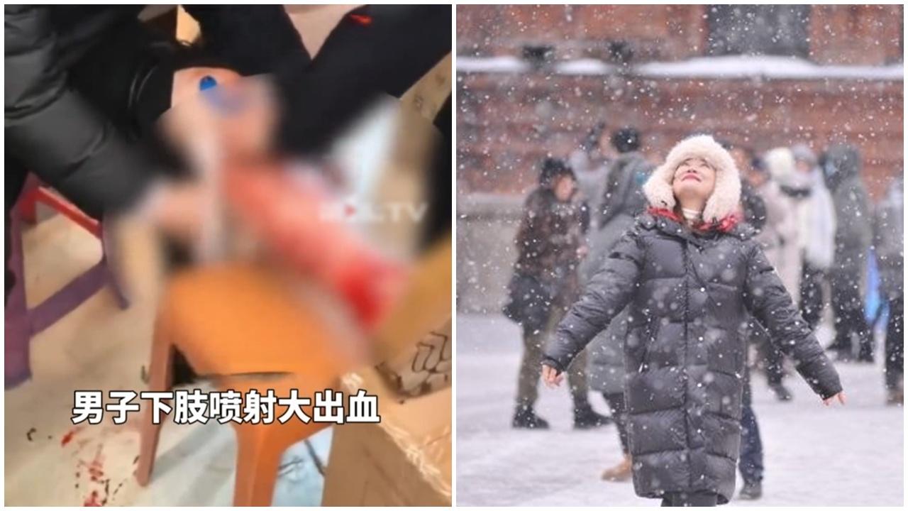 哈爾濱零下20度，男子靜脈曲張凍到爆血管。(微博)
