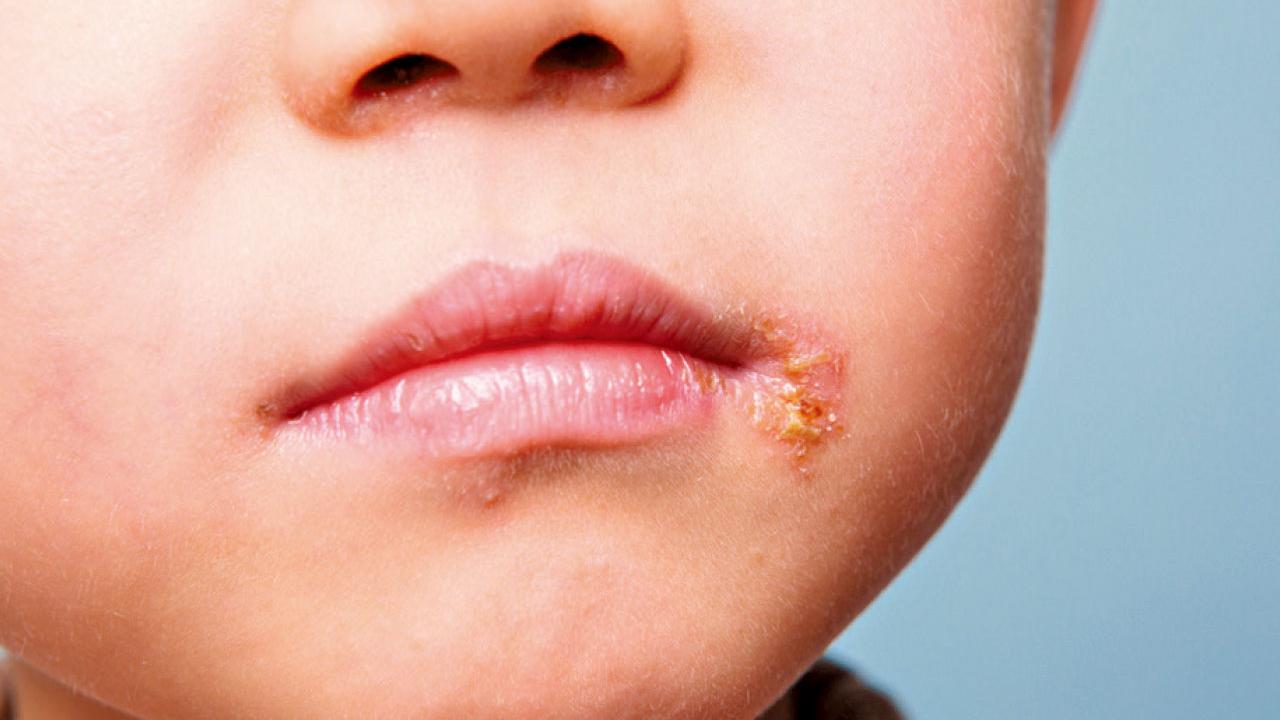 了解疱疹病毒在兒童中的感染(一)