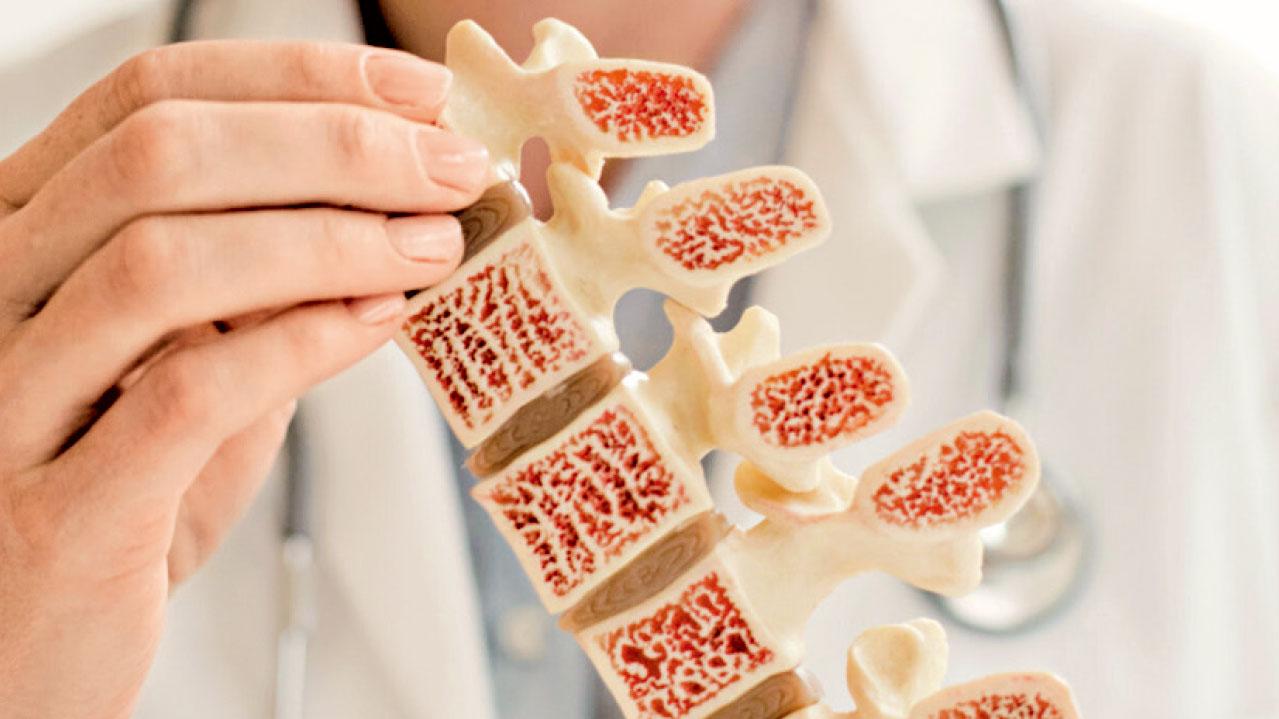 風濕病患者易致骨質疏鬆症