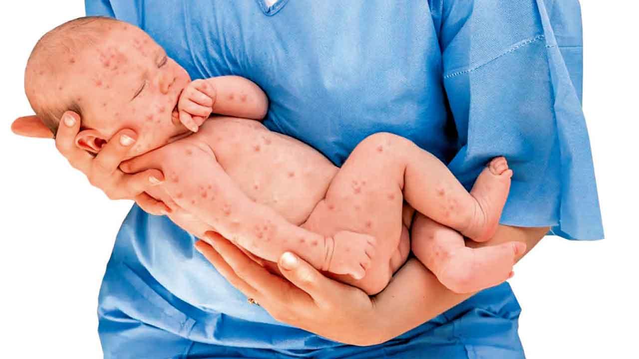 了解疱疹病毒在兒童中的感染(二)