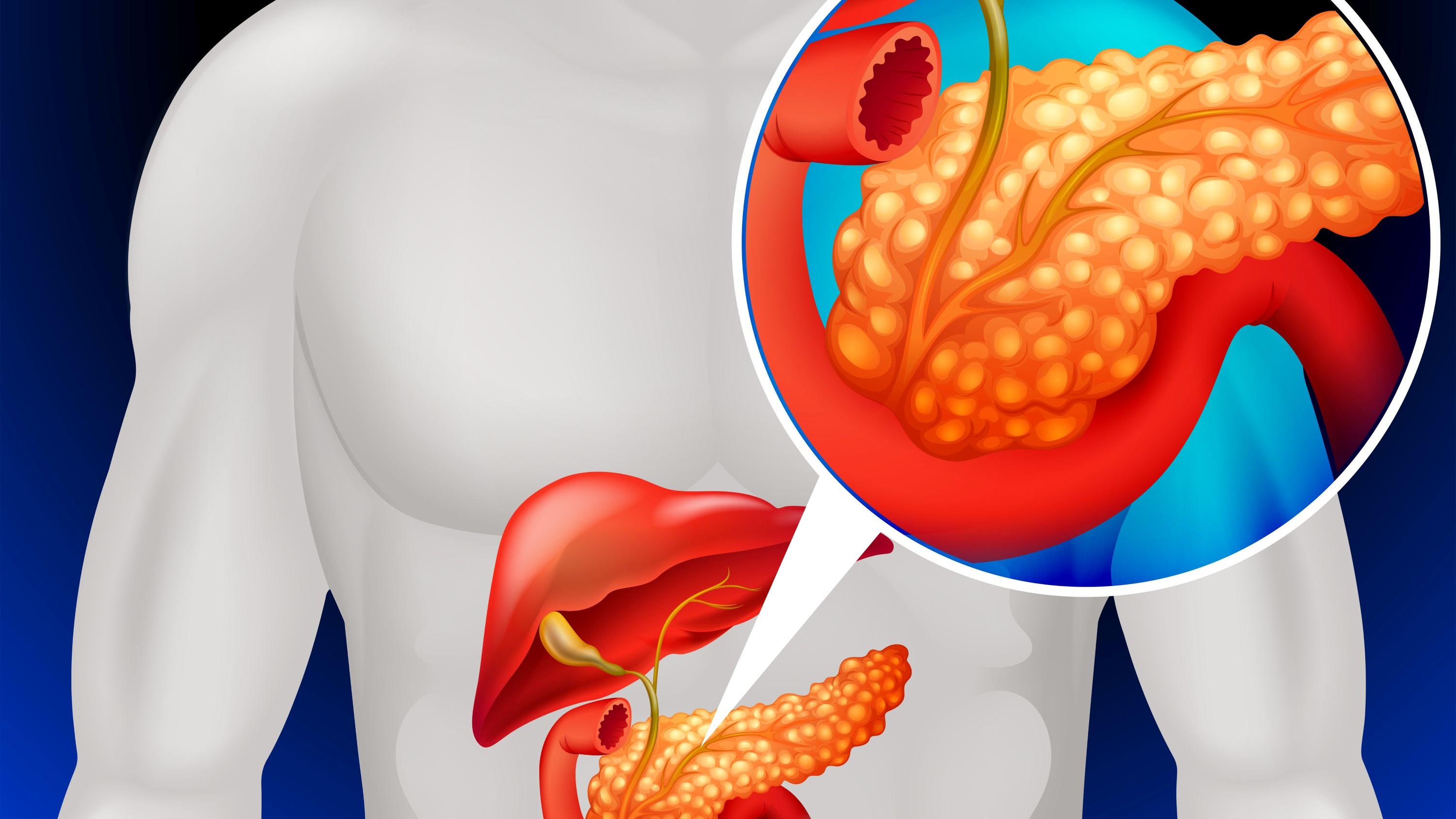 胰臟癌死亡率高 了解三大早期症狀 