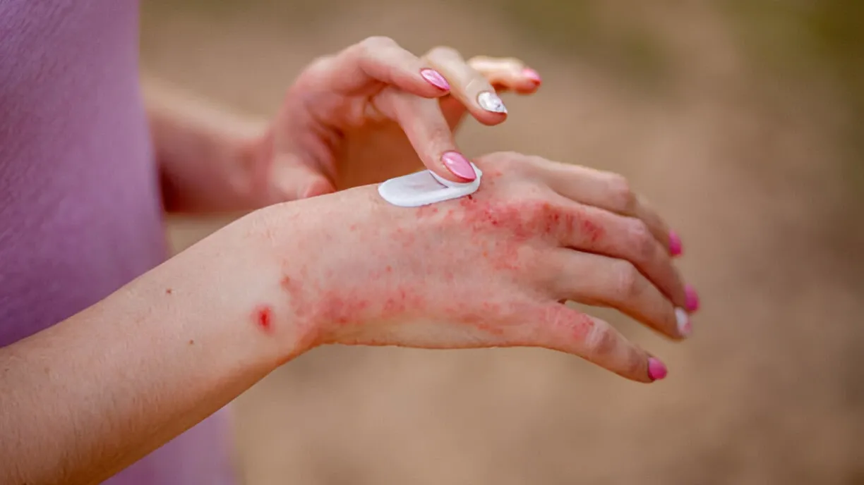 若異位性皮膚正在發作的期間，盡量減少富含組織胺或易使身體釋放組織胺的食物對症狀可能會有幫助。