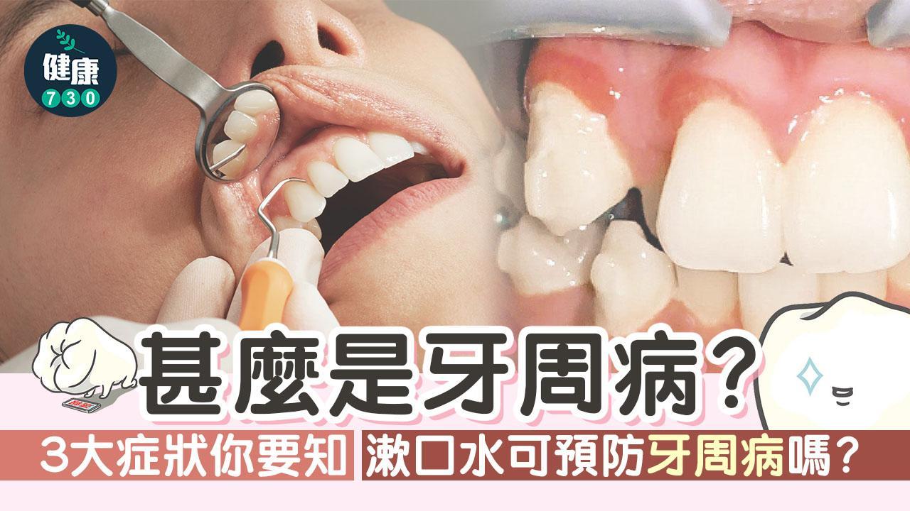 甚麼是牙周病？3大症狀你要知 牙醫詳解成因及治療方法