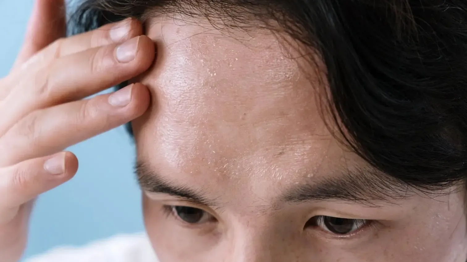 35歲男髮線後移「M字額」！中醫「1治療」改善脫髮、新髮生出
