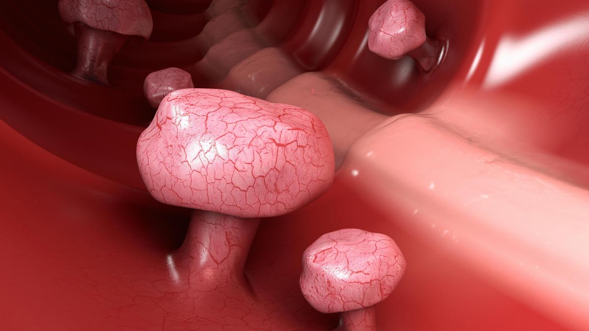 腸息肉別忽視 中醫藥可預防復發