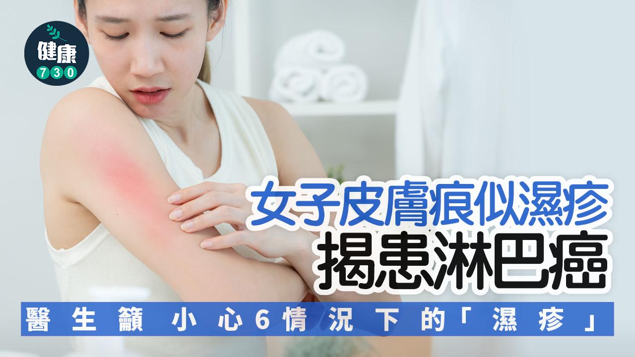 淋巴癌 癌症 皮膚痕癢 濕疹 發炎 痕癢