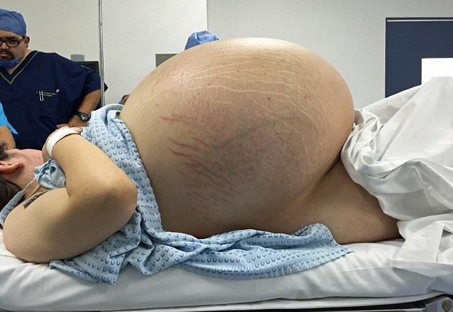 「懷胎11月誕10嬰」 墨女生瘤創紀錄