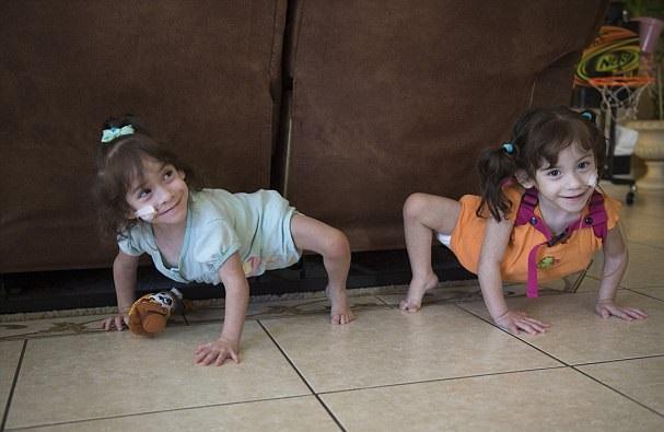 二人三足連體女 分割獨腿闖新生