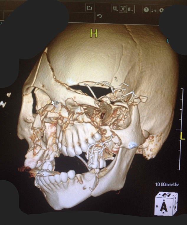 無纜安全帶 眼珠撞入鼻