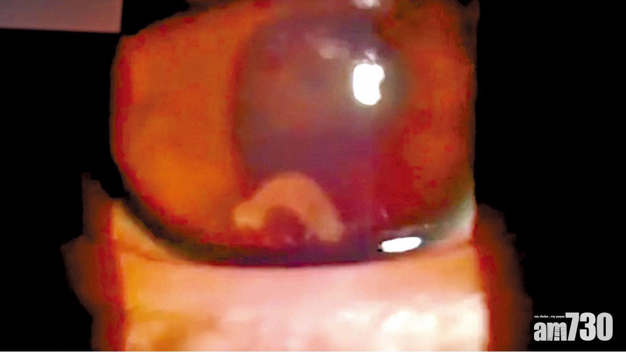 疼痛3周求醫揭罕症  少年吸蟲上眼幾盲