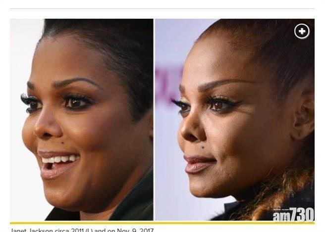 【即時娛樂】珍納積遜鼻子塌陷