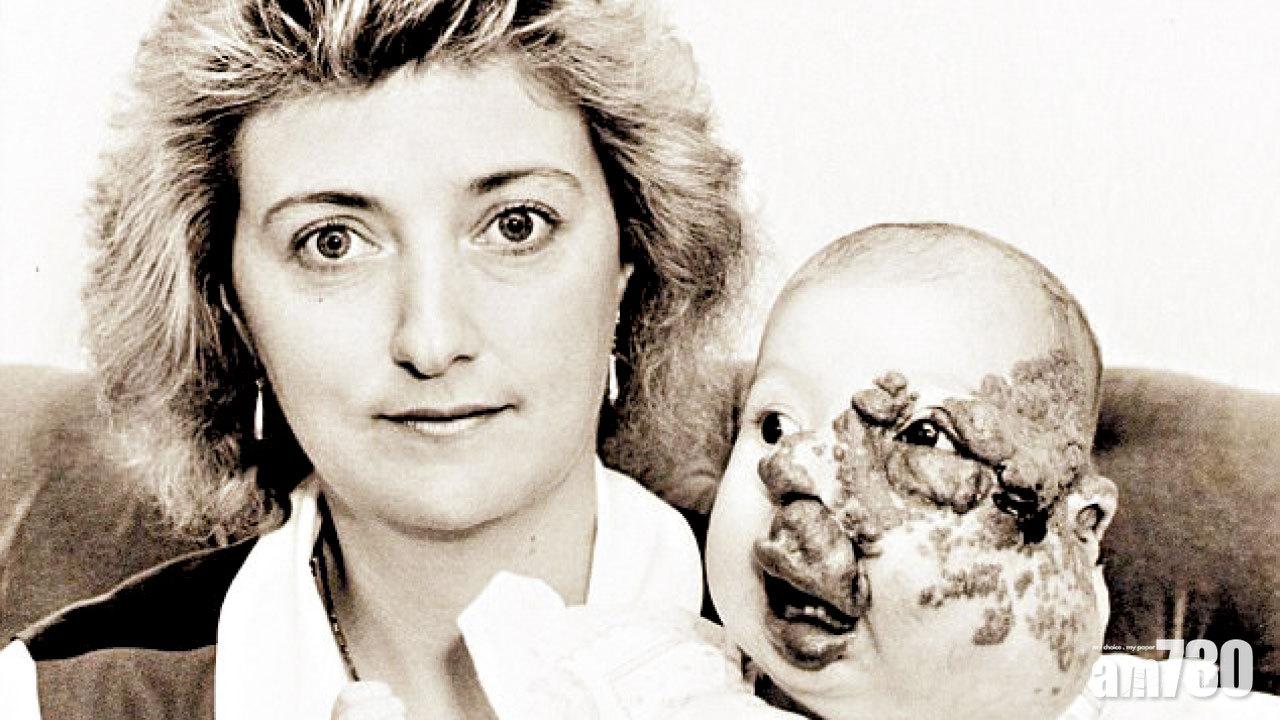 18次整形改寫厄運 胎痣女美滿于歸