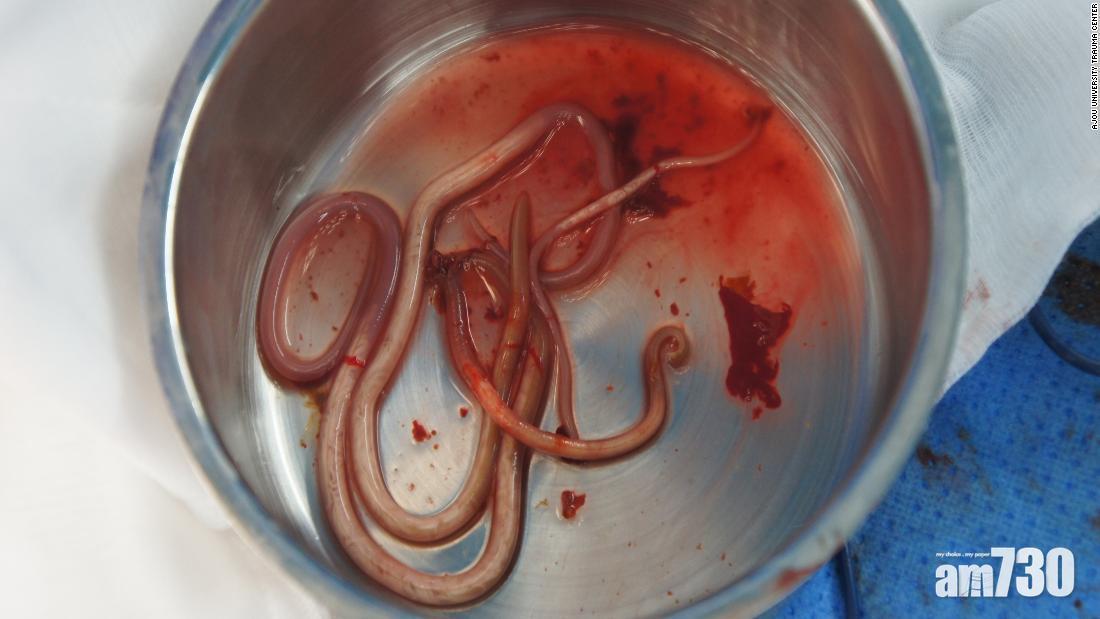 【噁心慎入】脫北士兵體內藏27厘米長寄生蟲