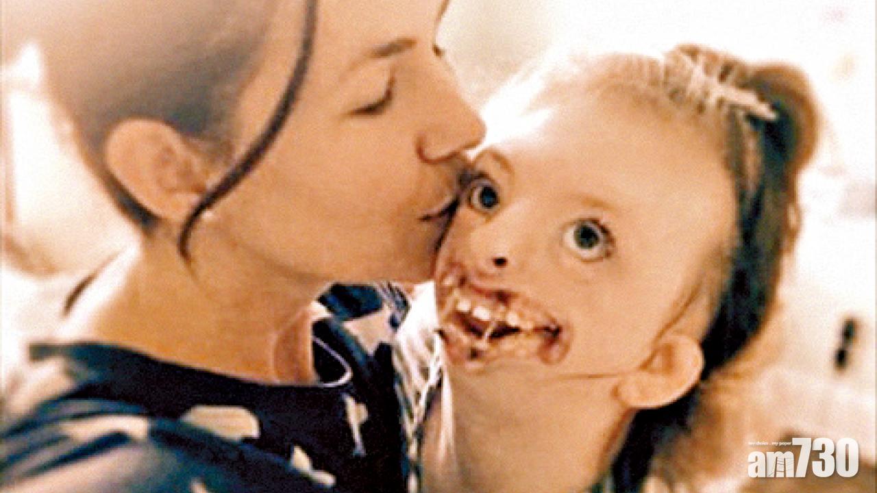 畸臉撐墮胎 Twitter認衰