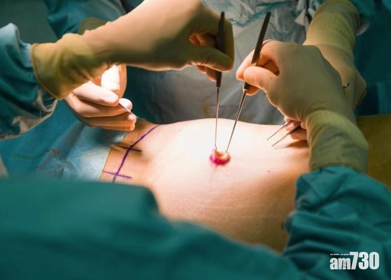 肚臍整形成歐美最新流行趨勢 