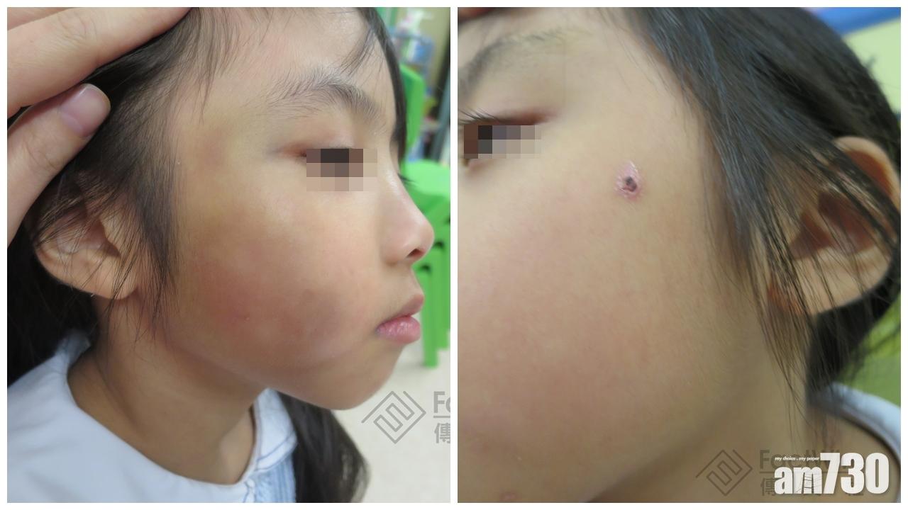 《傳真社》取得臨臨死亡前數個月相片  顯示校方曾發現傷痕