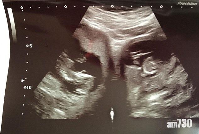 【五億分一機會】婦雙子宮同時懷孕 誕龍鳳胎
